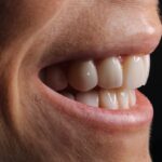 Veneers bieten besondere Vorzüge