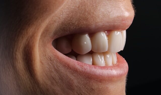 Veneers bieten besondere Vorzüge