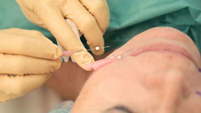 Fadenlifting als neue Geheimwaffe in der Beauty-Branche