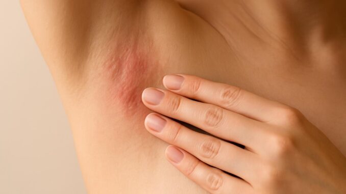 Akne Inversa richtig behandeln