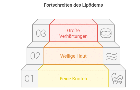 Die 3 Stadien des Lipödems - Grafik